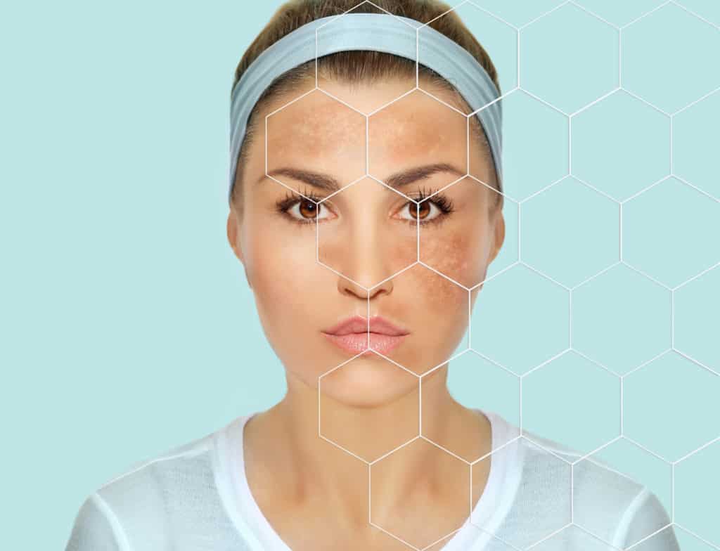 What is the Best Treatment for Melasma? What are its Diagnosis and Symptoms?