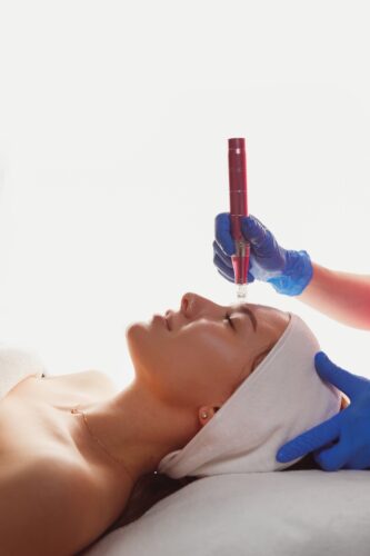 SkinPen treatment
