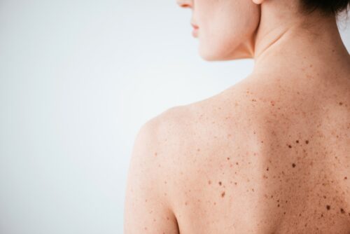 womans back with dark spots