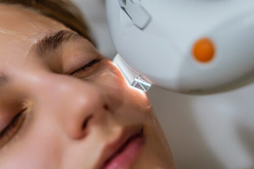 close up of facial MOXI laser procedure