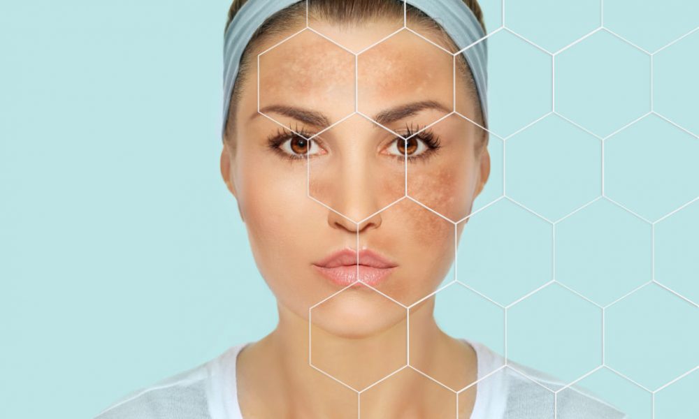 What is the Best Treatment for Melasma? What are its Diagnosis and Symptoms?